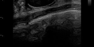 Breast Fibroadenoma