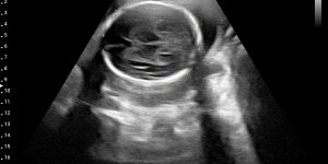 Fetus - 24 Weeks