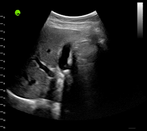 Gall Bladder Stones