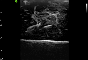 Needle Guided Aspiration