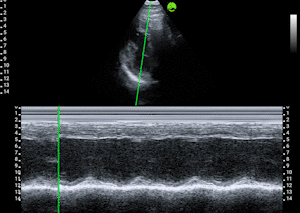Parasternal Short-Axis - M-Mode