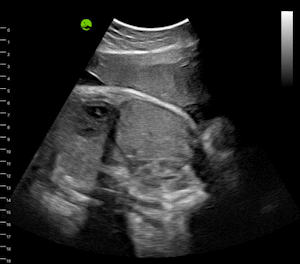 Fetus - 37 Weeks