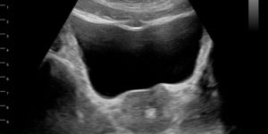 Prostate Gland