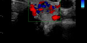 Thyroid